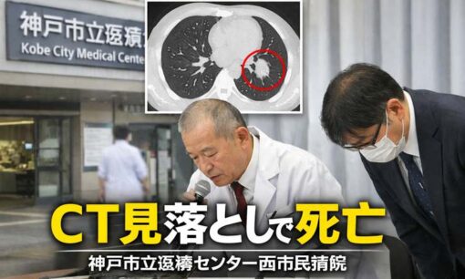 【70代女性死亡】神戸市立医療センター西市民病院でCT見落とし医療事故　読影体制の盲点が露わに