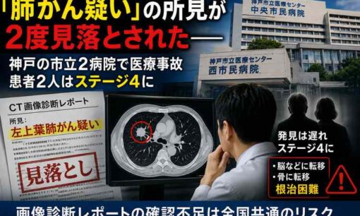 肺がん見落としで患者2人がステージ4　神戸市民病院機構、3カ月前にも死亡事故を公表